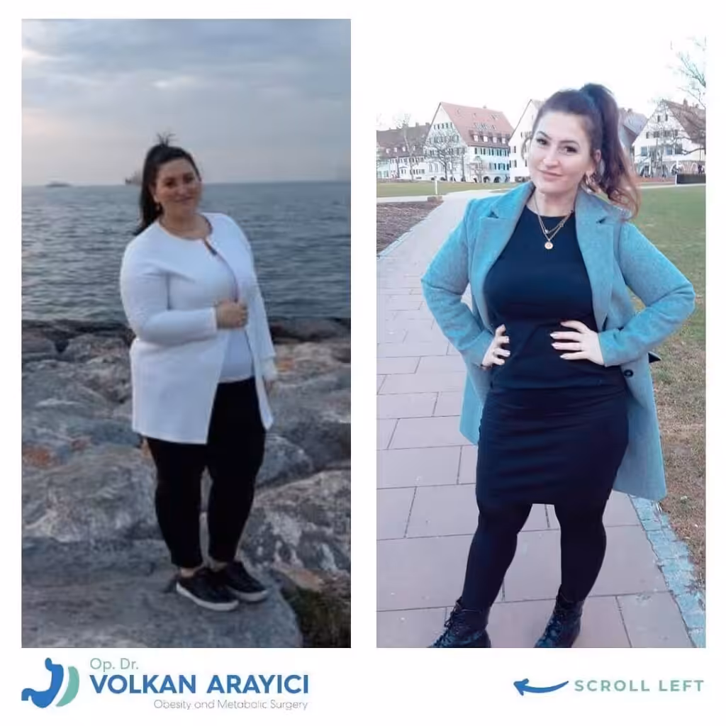 How safe is gastric sleeve surgery in Turkey? safe gastric sleeve surgery in Turkey before and after photo