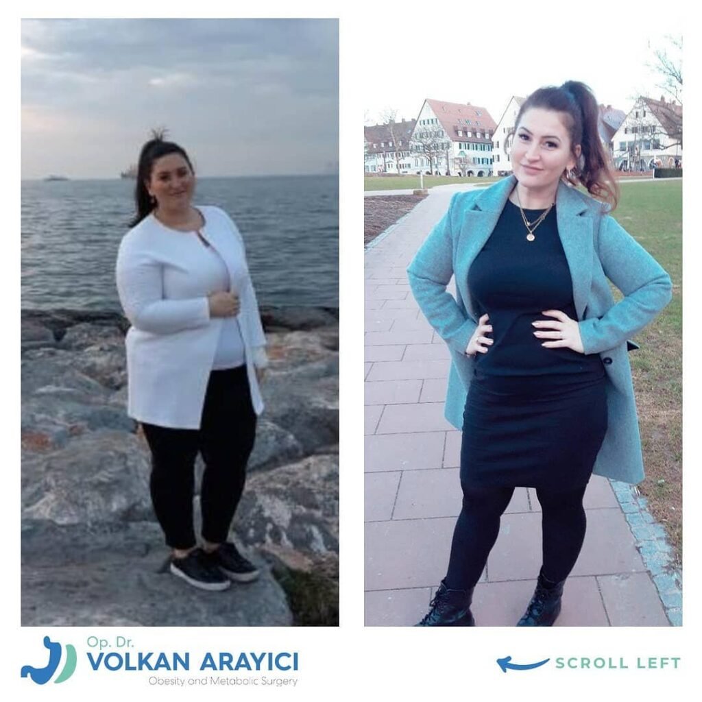 safe gastric sleeve surgery in Turkey before and after photo