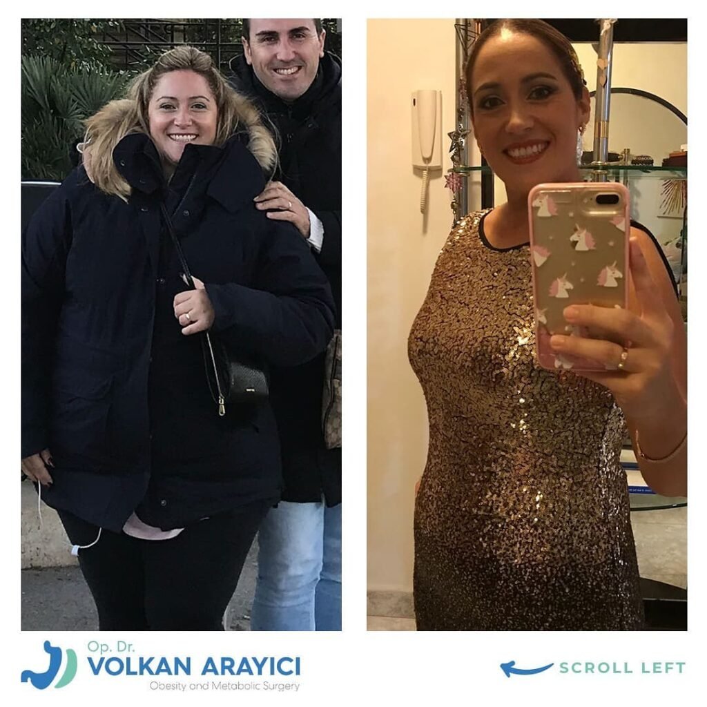 Manga Gastrica Turquia İzmir Costos Manga Gastrica Turquia izmir