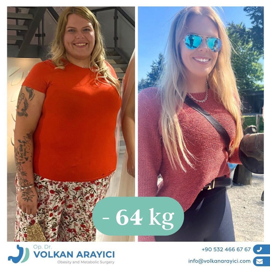 gastric sleeve Turkey experiences - before and after transformation