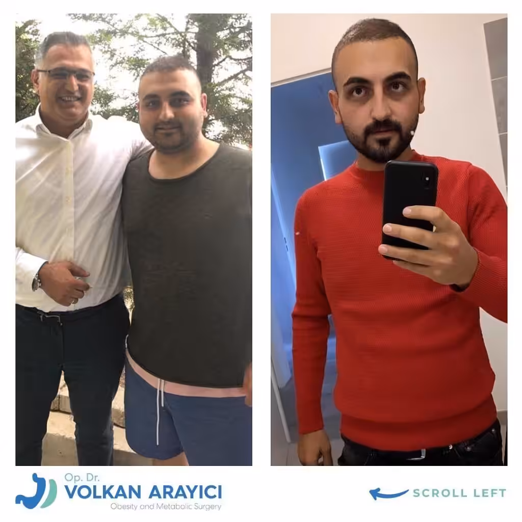 Experiencias Manga Gastrica Turquía reduccion de estomago en turquia opiniones 1