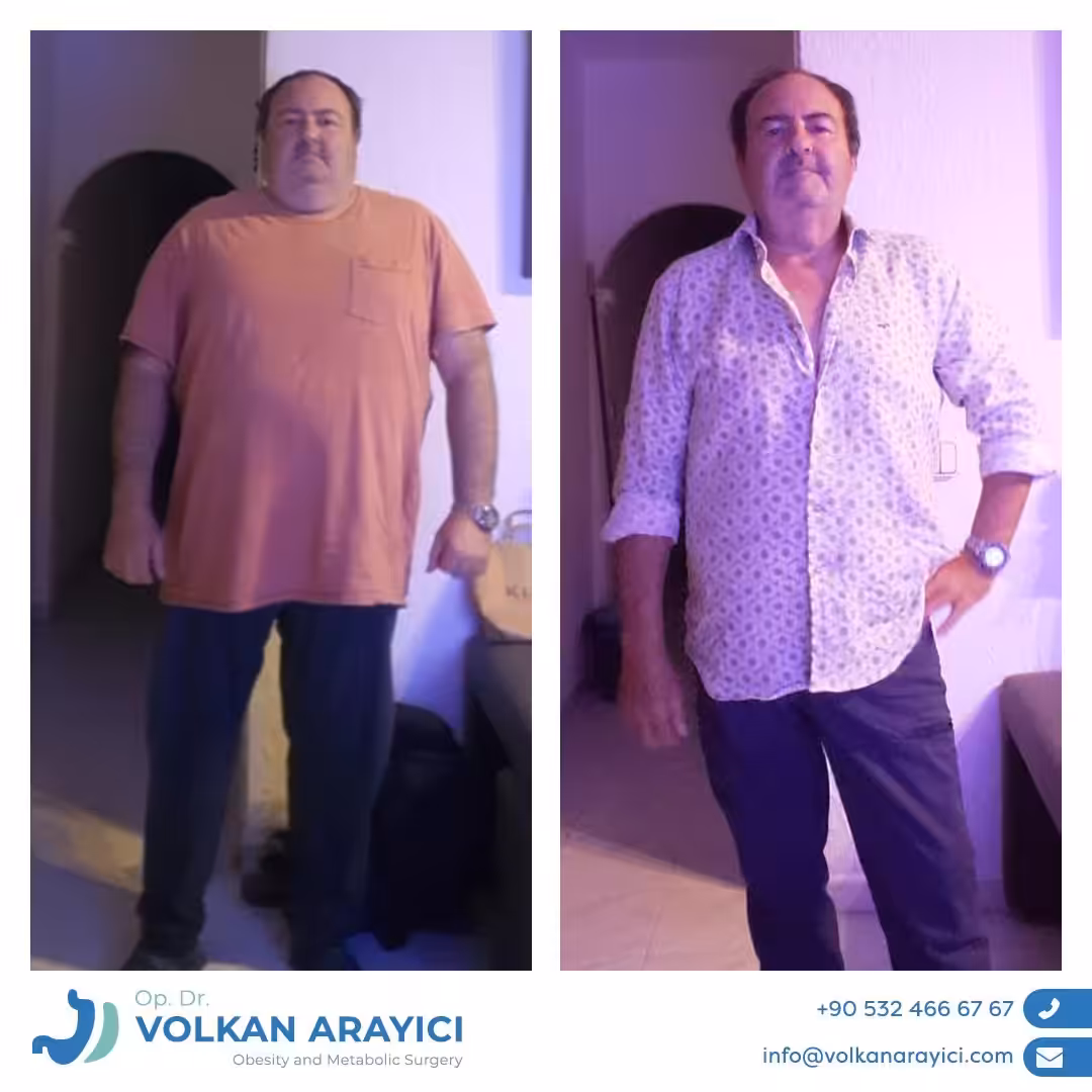 mini bypass gastrico turquia costo