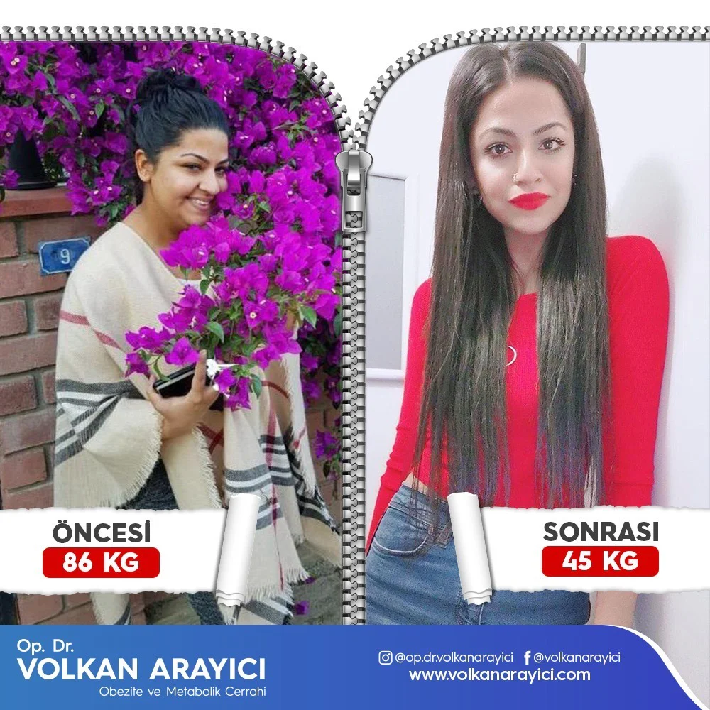 Gastric Sleeve Turkey İzmir 29b973f3 78fd 414e b3bb 947c327aebb5