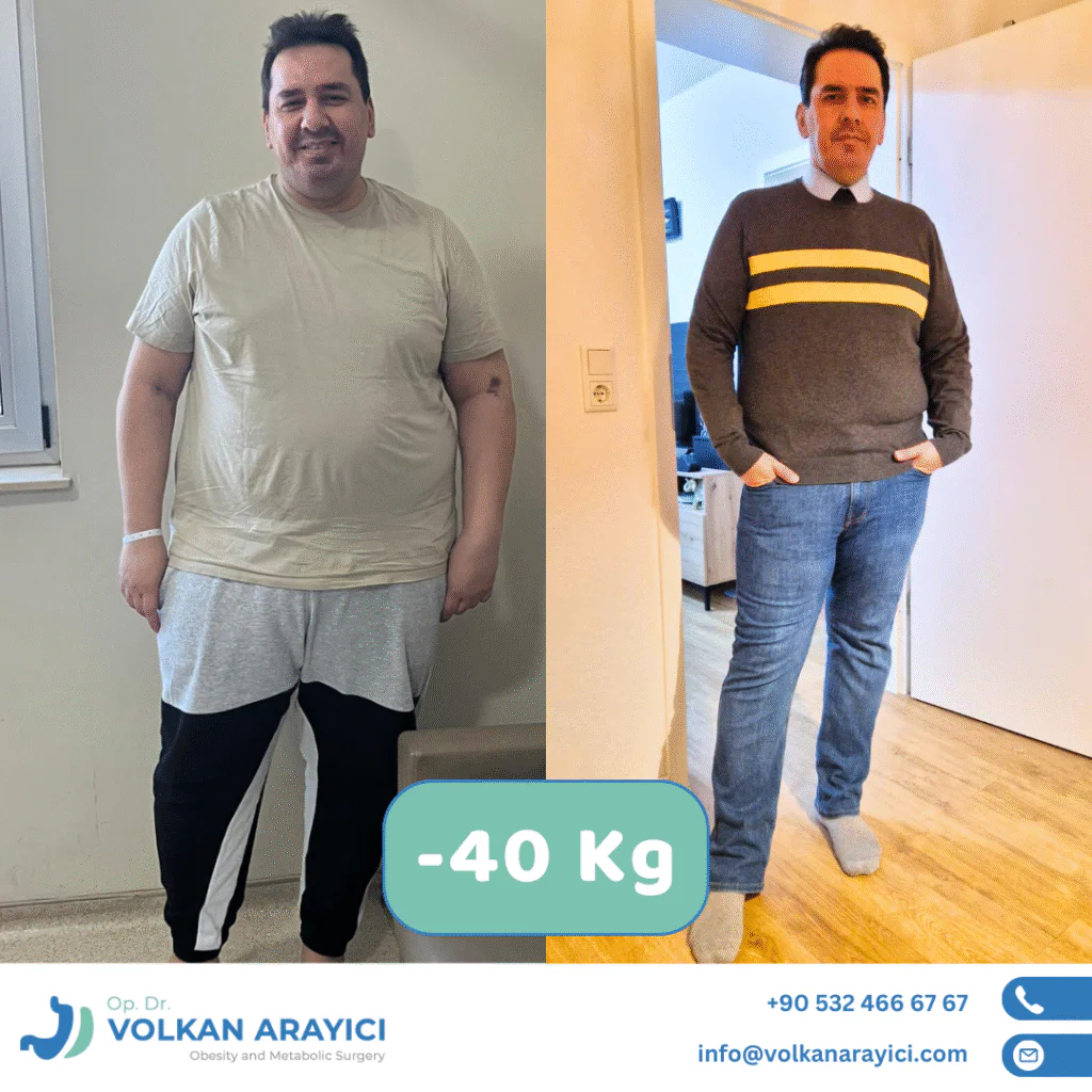 Mini Gastric Bypass Turkey: The First Step to a Healthy Life Mini Gastric Bypass Turkey