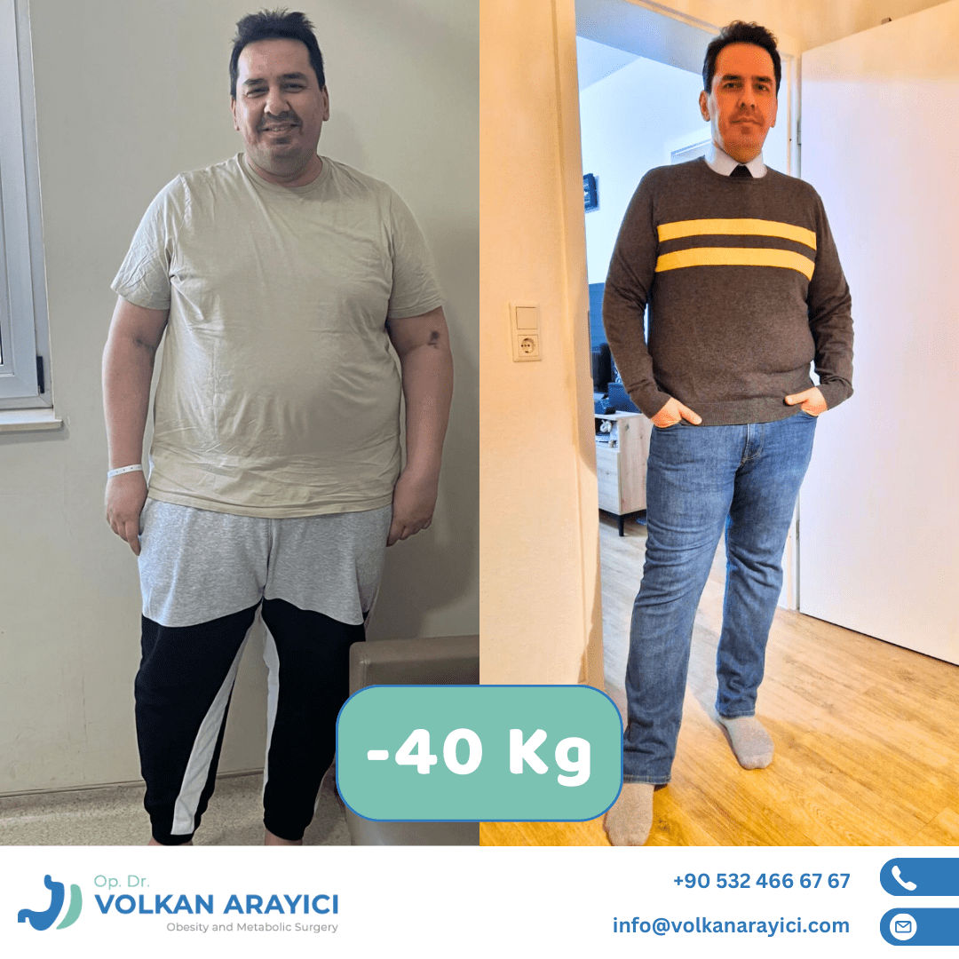 Mini Gastric Bypass Turkey: Your Complete Guide