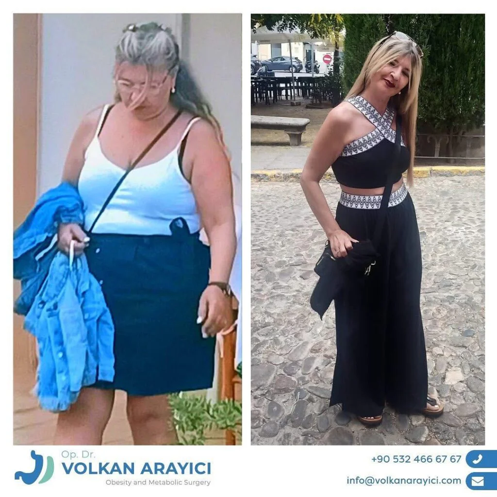 Mini Gastric Bypass Turkey: The First Step to a Healthy Life Mini Gastric Bypass Turkey success story