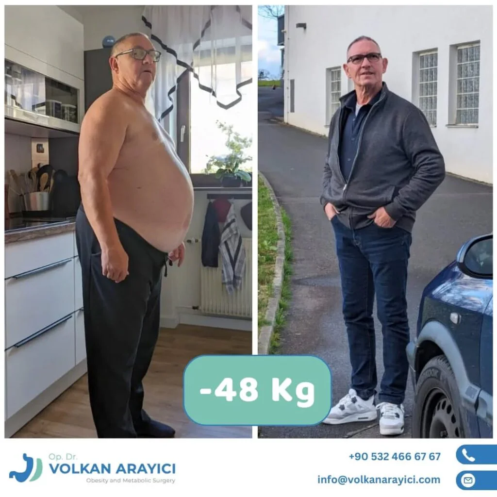 Bariatrische Eingriffe: Effektive Lösungen für Gewichtsverlust und Gesundheit Vorher-Nachher-Bilder von bariatrischen Eingriffen