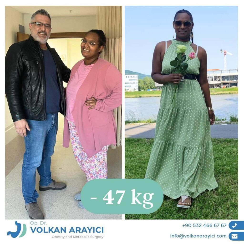 Weight loss transformation after bariatric surgery in Turkey