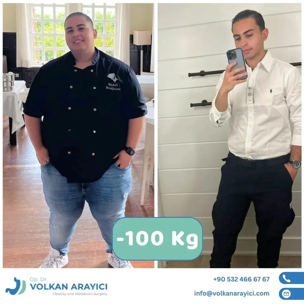 Mini Gastric Bypass Turkey: The First Step to a Healthy Life Weight loss transformation with Mini Gastric Bypass Turkey