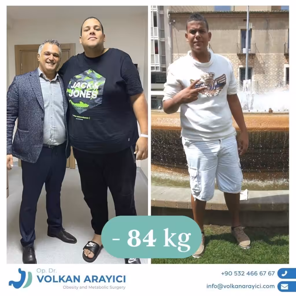 Alles über die Sleeve Magen Operation und ihre Vorteile before and after post 111 p1gLe 1