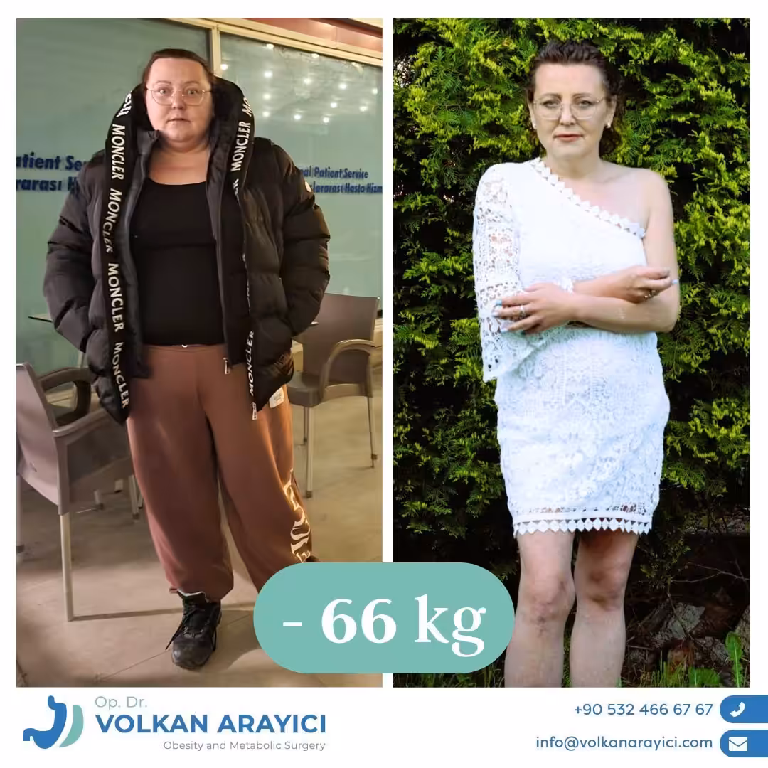 Auf dem Weg zu Ihrem neuen Leben durch Schlauchmagenverkleinerung in der Türkei before and after post 4VPJX 1