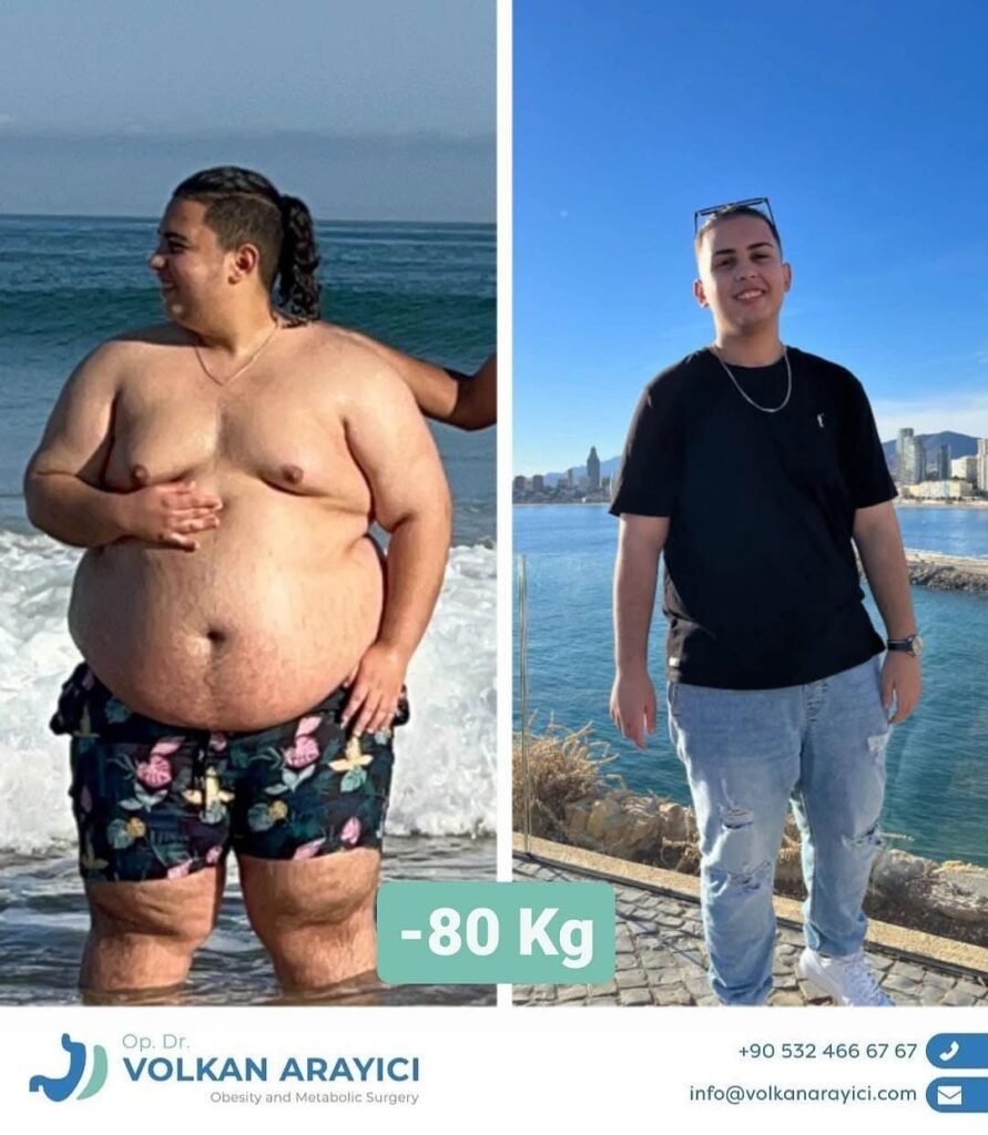 Patients choosing weight loss surgery in Turkey benefit from advanced medical technology and experienced bariatric surgeons
