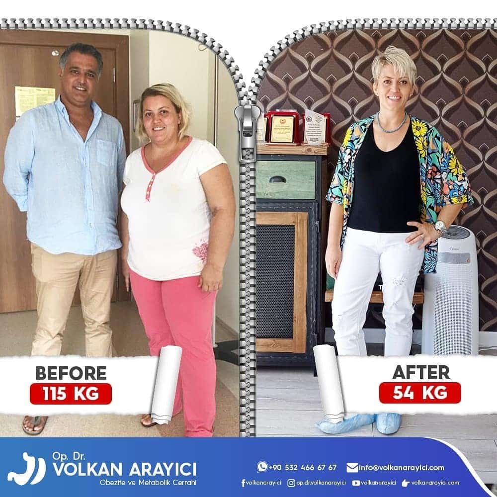 Ein Schritt zu einem neuen Leben mit der Magenschlauch Op magenschlauch op türkei vorher nachher