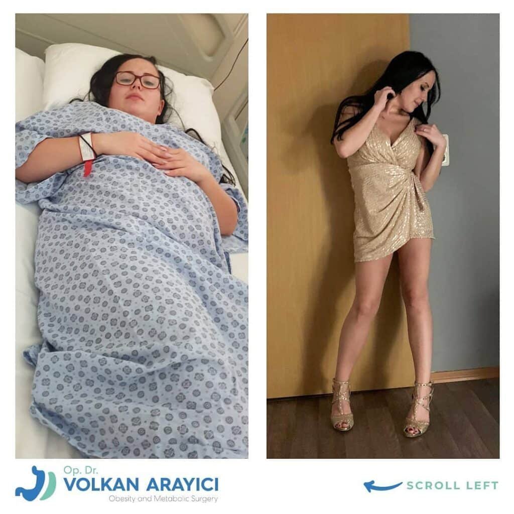 Ein Schritt zu einem neuen Leben mit der Magenschlauch Op magenschlauch op türkei vorher nachher