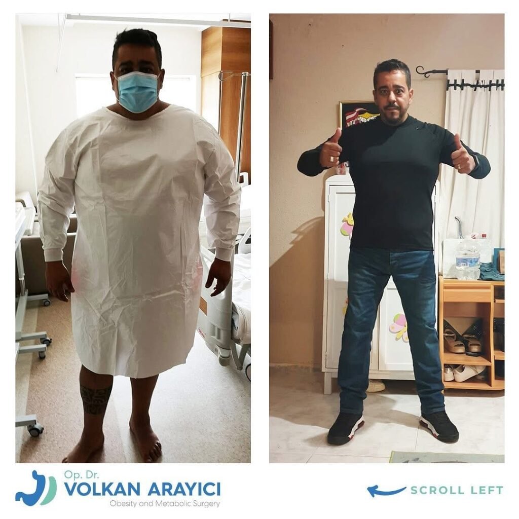 Sleeve Magen türkei vorher nachher bild