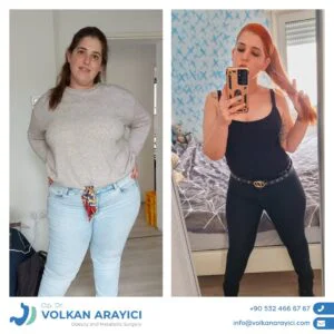 MagenBallon Türkei Kosten magenballon türkei kosten