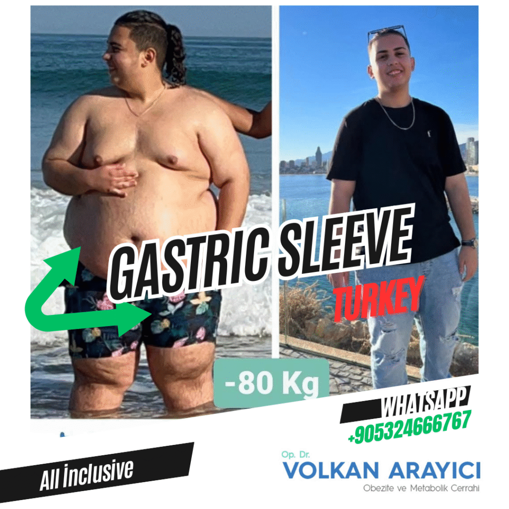 Cicatrices de la Bypass Gastrico