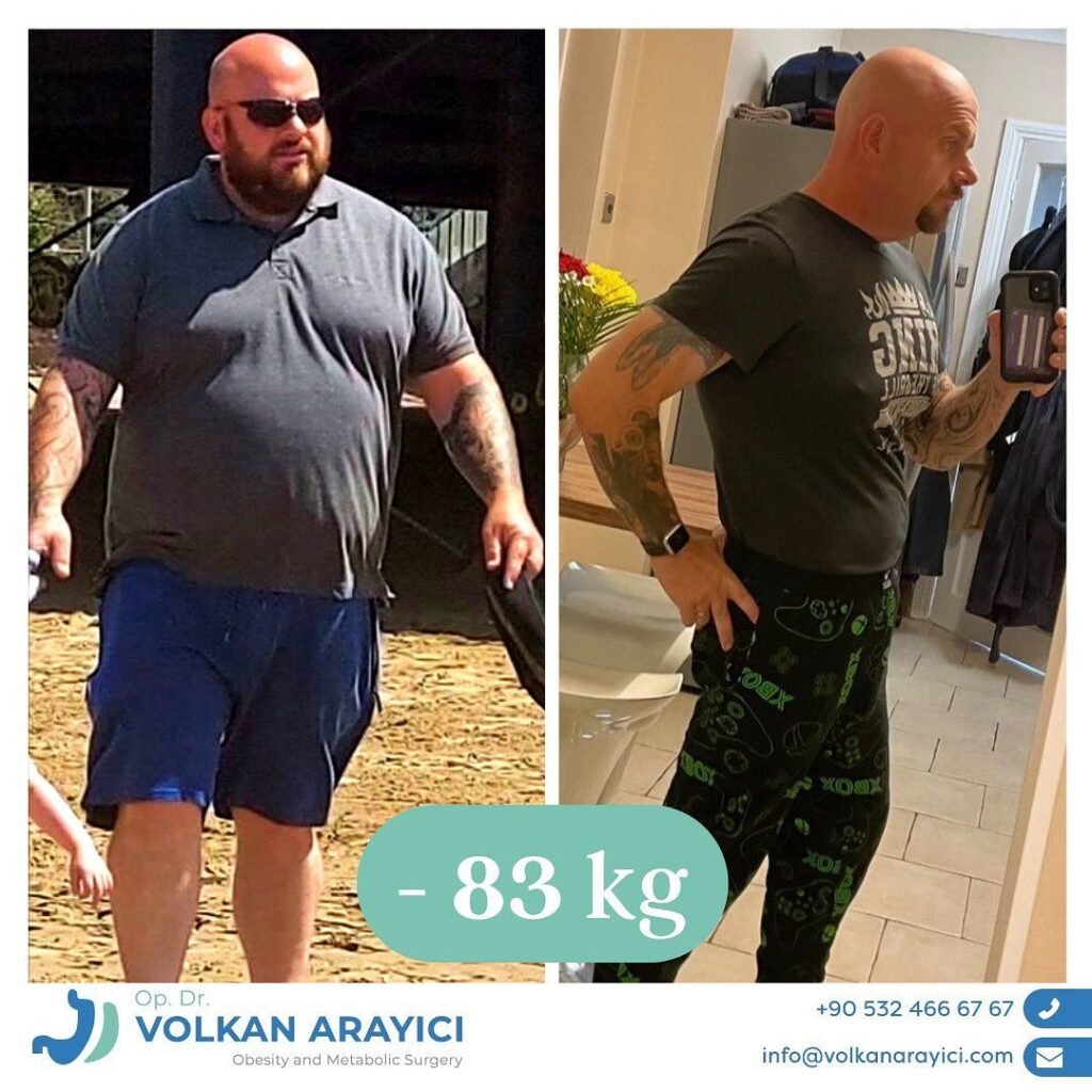 Gastric Bypass Turkey Best Clinic