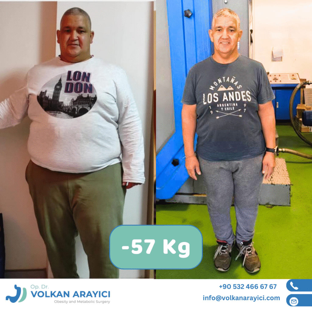 Gastric Resleeve Turkey