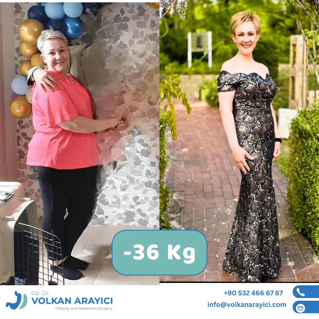 About us Gastric Sleeve Turkey All-Inclusive Price