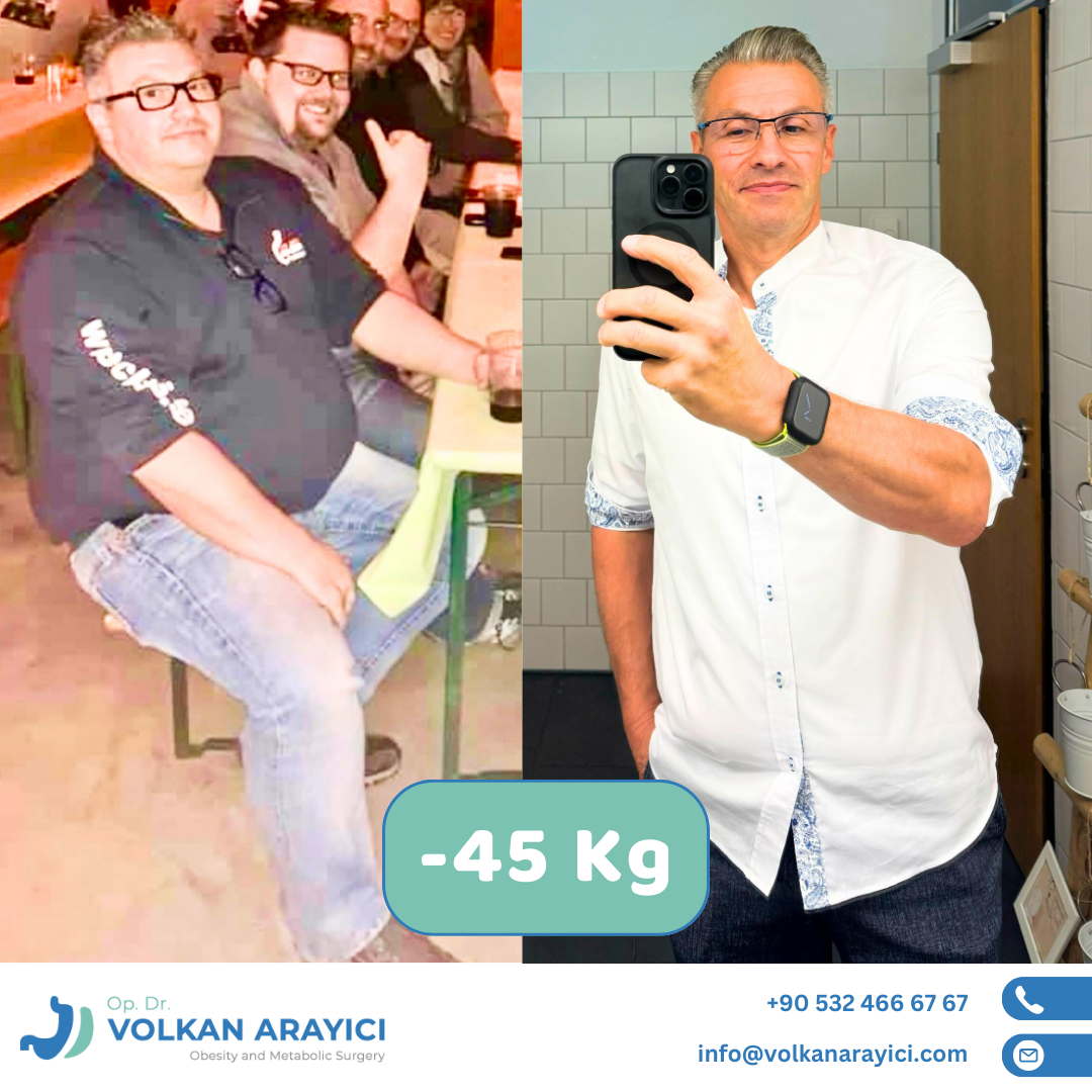 Gastric Sleeve Turkey Izmir