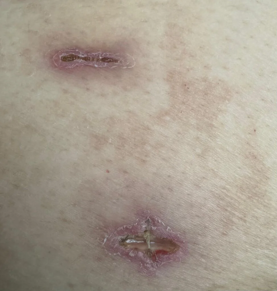 Gastric Sleeve Scars: A Guide to Healing Gastric Sleeve Scars Healing