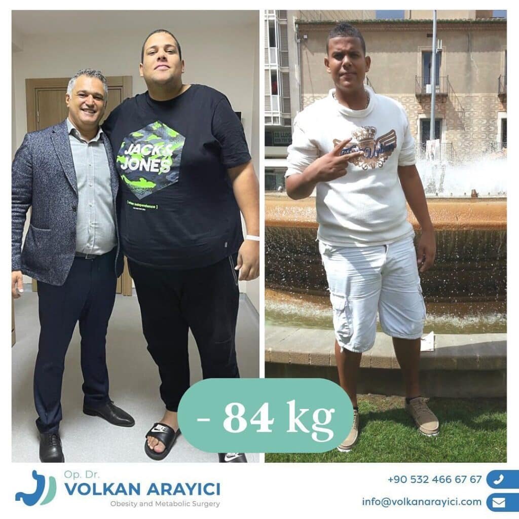 Manga Gastrica Turquia Mejor Clinica