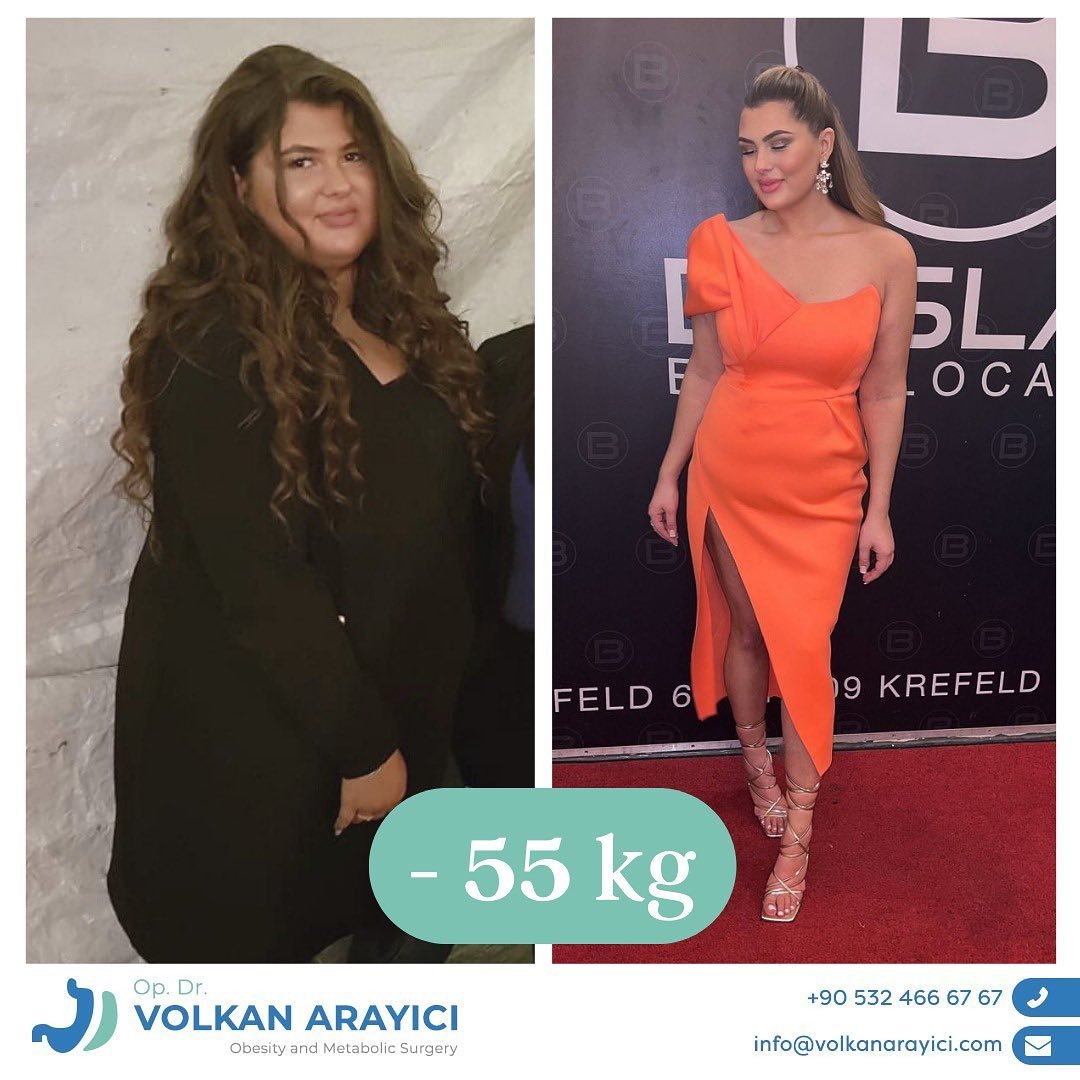 Revisionchirurgie Türkei Vorher Nachher Bilder 1