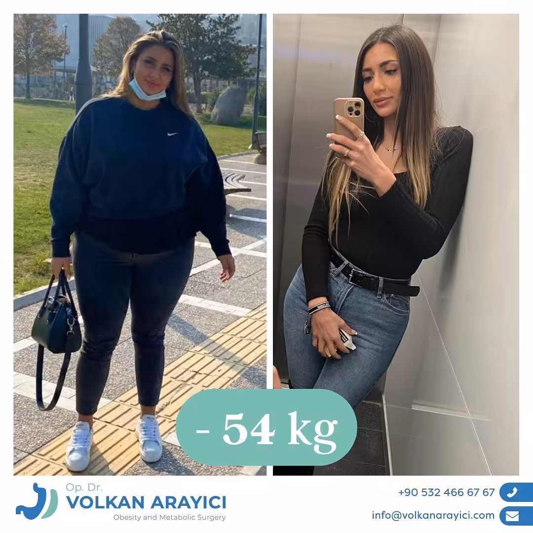 Revisionchirurgie Türkei Revisionchirurgie Türkei Vorher Nachher Bilder