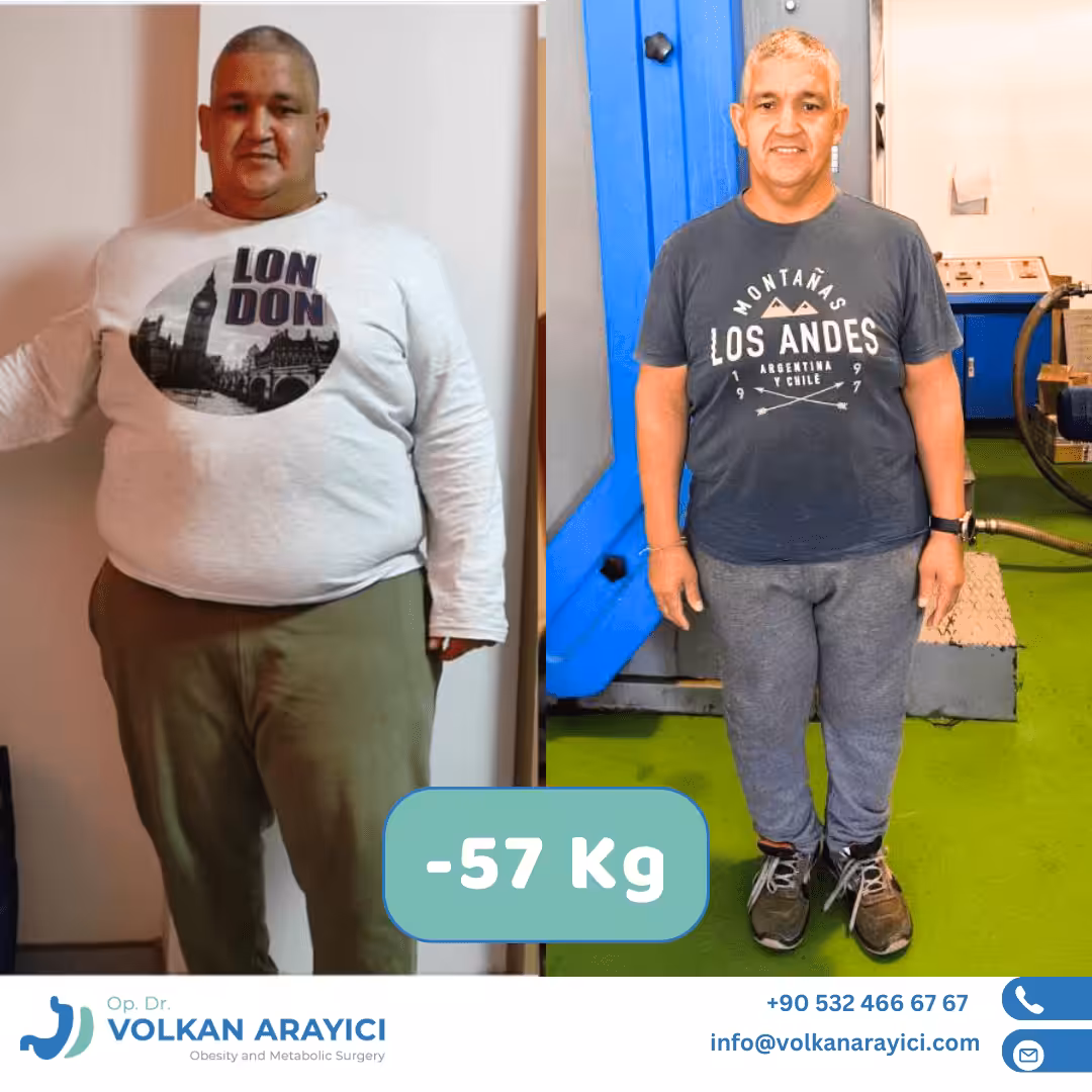 gastric sleeve turkey experiences