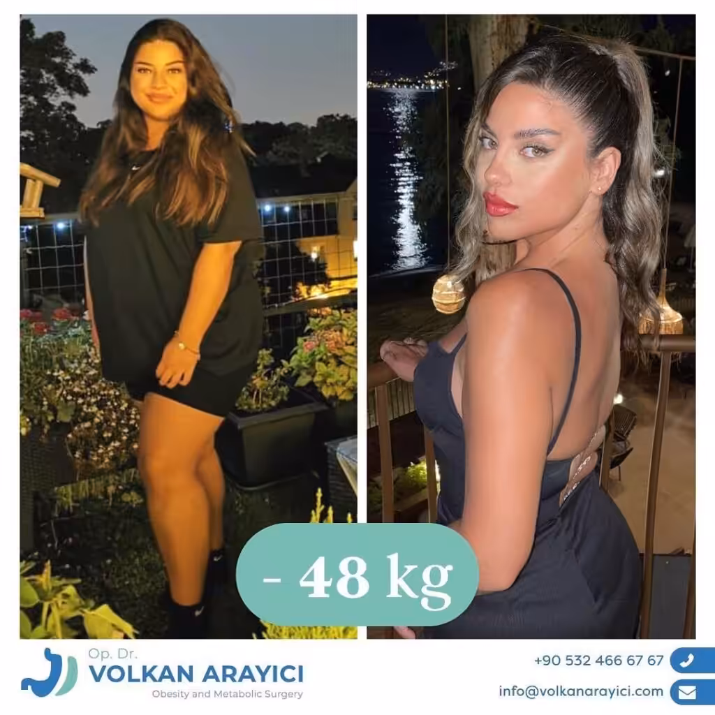 Cirugía Bariátrica Turquía: Su Camino a una Vida Saludable la mejor clínica de obesidad antes despues