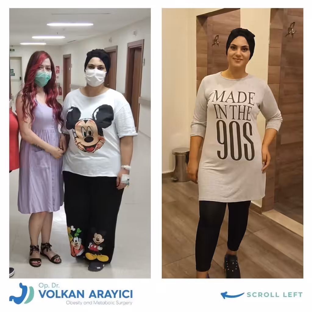 La Mejor Clínica para Reducción de Estómago en Turquía: Guía Completa recuperacion despues de un bypass gastrico