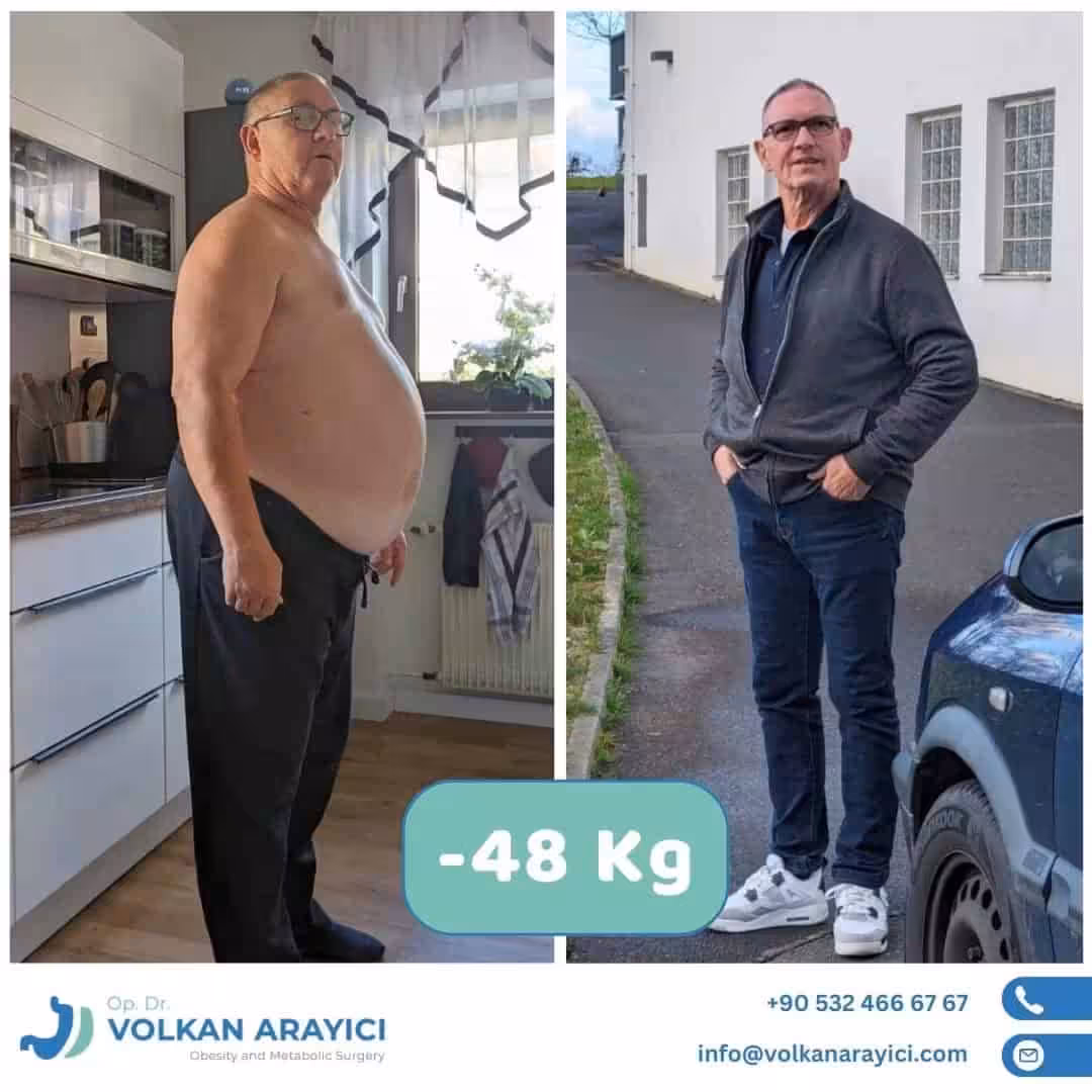 Schlauchmagen Türkei Schlauchmagen Türkei Erfahrungen