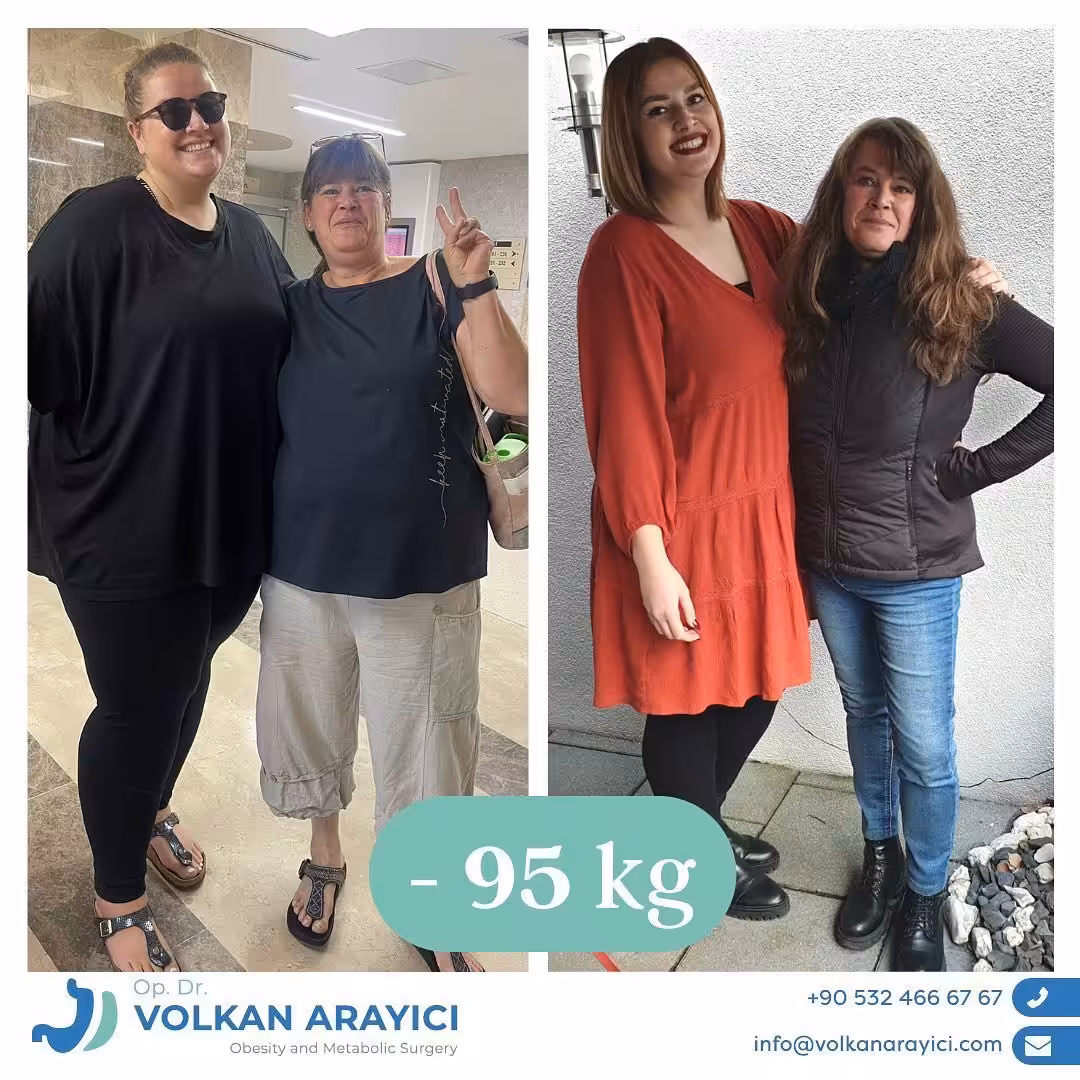 Schlauchmagen Türkei schlauchmagen türkei izmir - Schlauchmagen in der Türkei, Izmir - Zwei enge Freunde reisten von Deutschland nach Izmir in der Türkei und unterzogen sich am selben Tag einer Schlauchmagen-Operation durch Dr. Volkan Arayıcı. Neun Monate nach der Operation wurden sie zusammen fotografiert. Beide verloren insgesamt 95 Kilo.