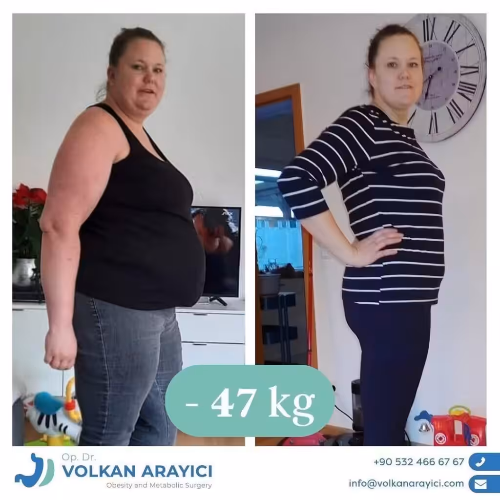 Cirugía Bariátrica Turquía: Su Camino a una Vida Saludable tratamiento de obesidad en turquia