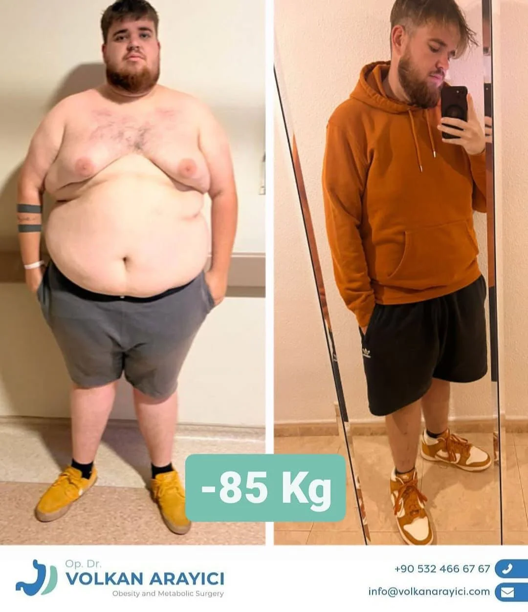 Bypass Gastrico Turquia Antes y despues imagenes