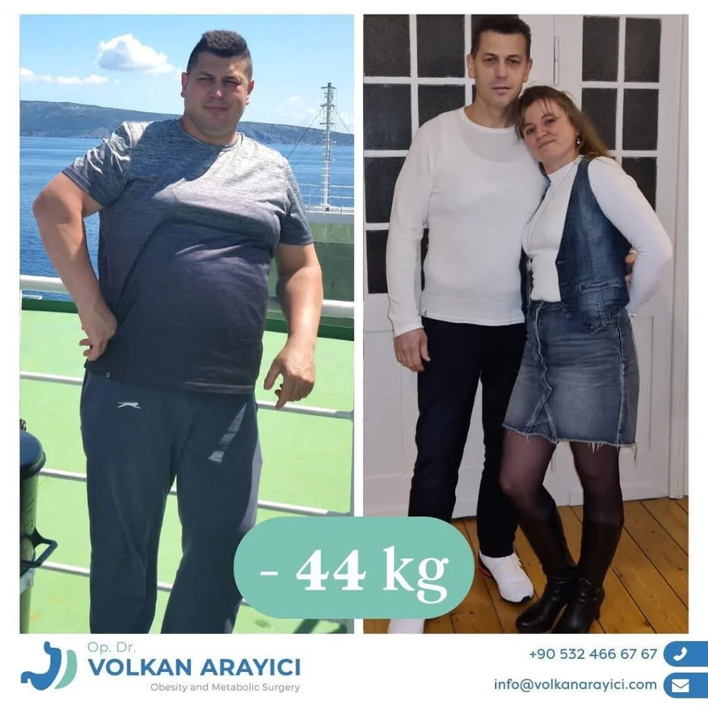 Gewichtsreduktion Türkei: Ihr Weg zu einem gesunden Leben gewichtsreduktion türkei Vorher Nachher