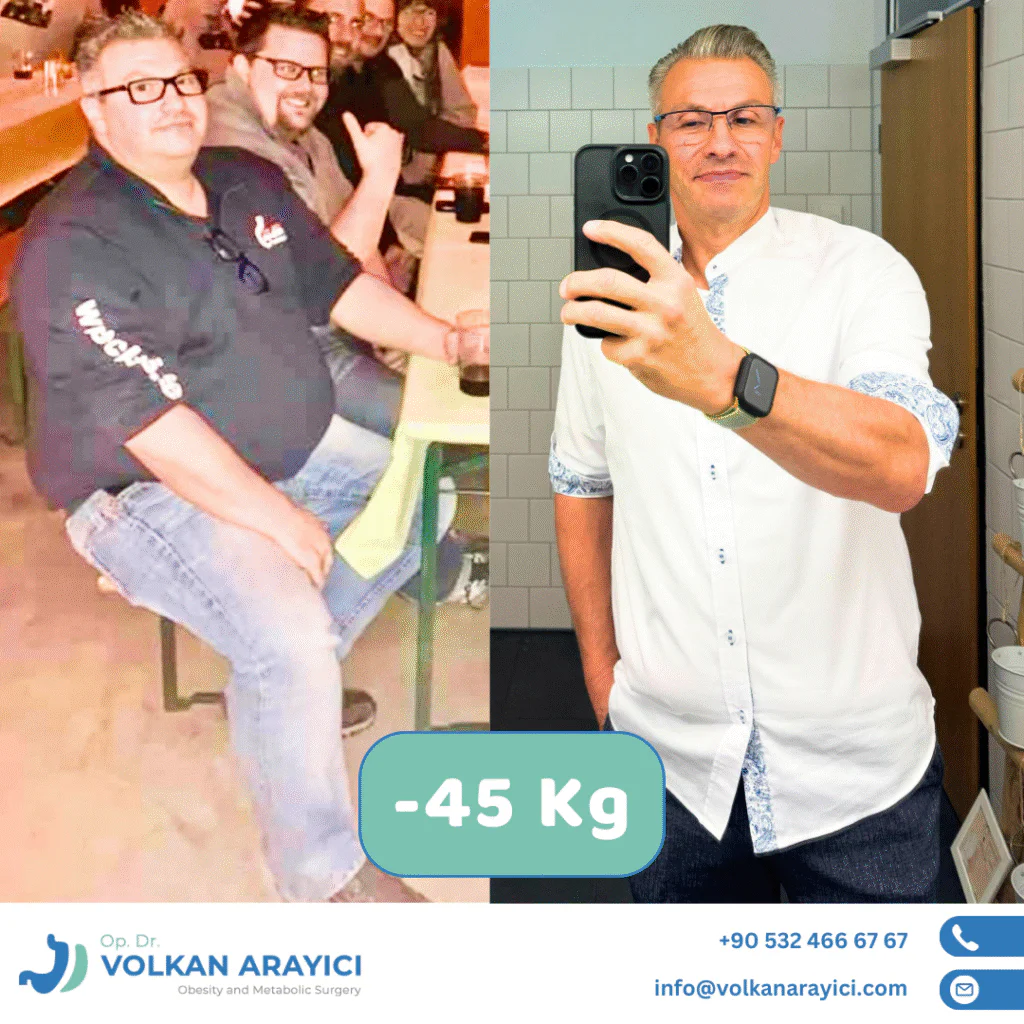 Mini Gastric Bypass in Turkey Mini Gastric Bypass in Turkey Before After Photo