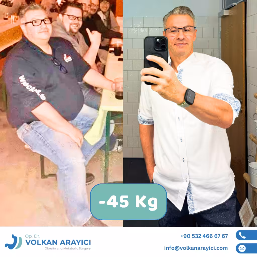 Mini magenbypass in der türkei