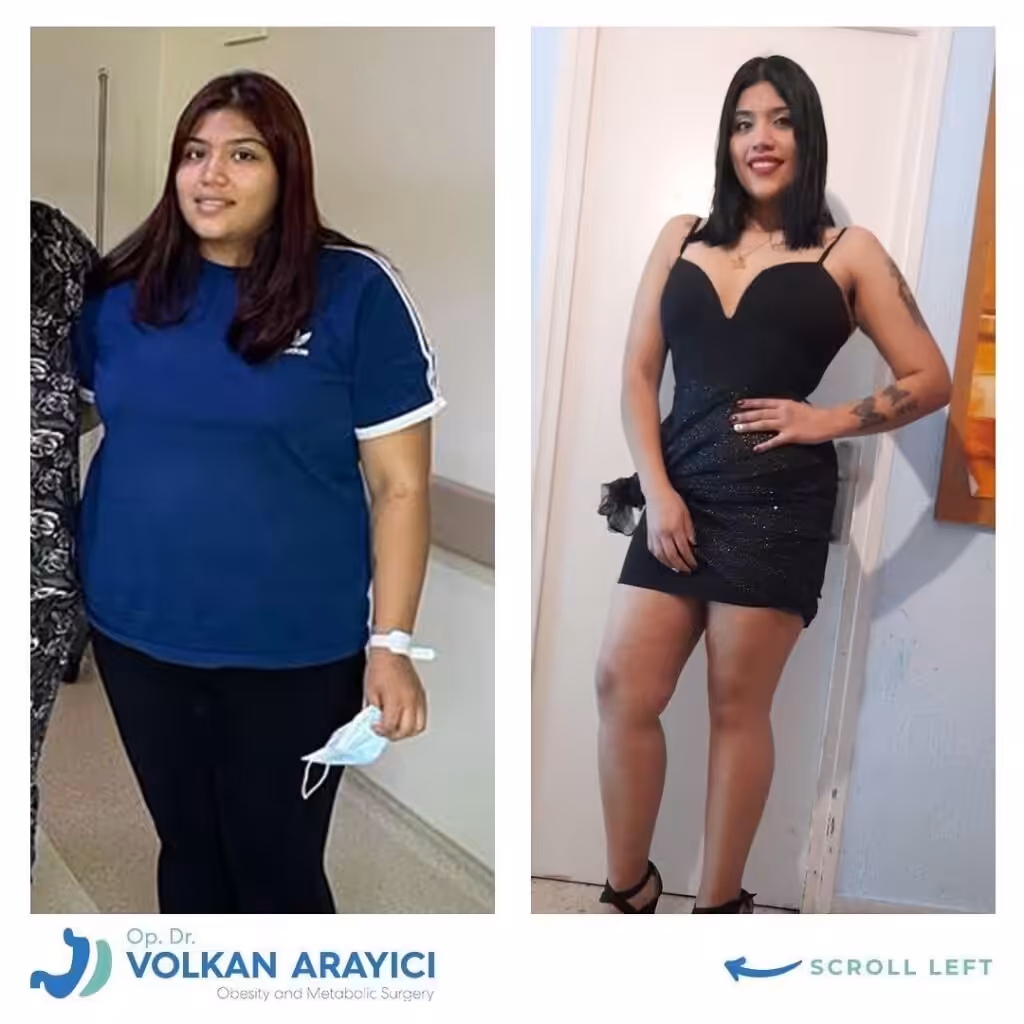 perdida de peso en turquia antes despues
