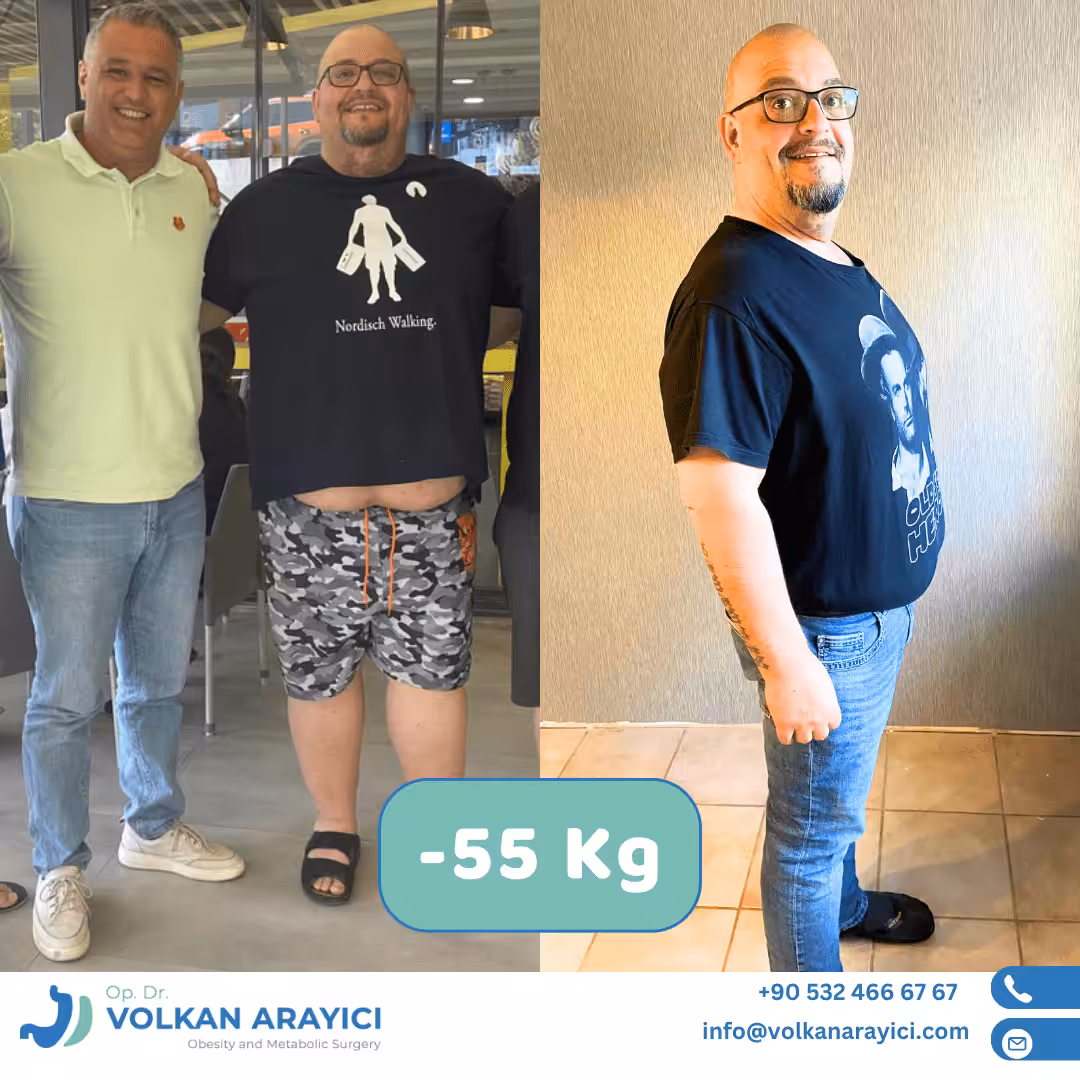 Schlauchmagen Türkei Schlauchmagen Türkei Beste Klinik - Klaus, der seit Jahren mit Fettleibigkeit kämpft, reiste von Deutschland ins türkische Izmir, um sich einer Schlauchmagen-Operation zu unterziehen, da seine deutsche Krankenkasse die Kosten nicht übernahm. Nach der Operation verlor er 55 Kilo. Er sagt, die Klinik von Dr. Volkan Arayıcı sei die beste Klinik für Schlauchmagen.