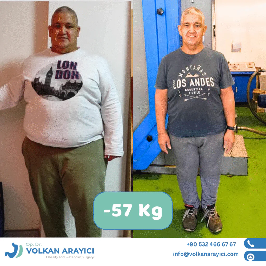 Manga Gastrica y Diabetes: Una Guía Completa tratamiento de la diabetes tipo 2