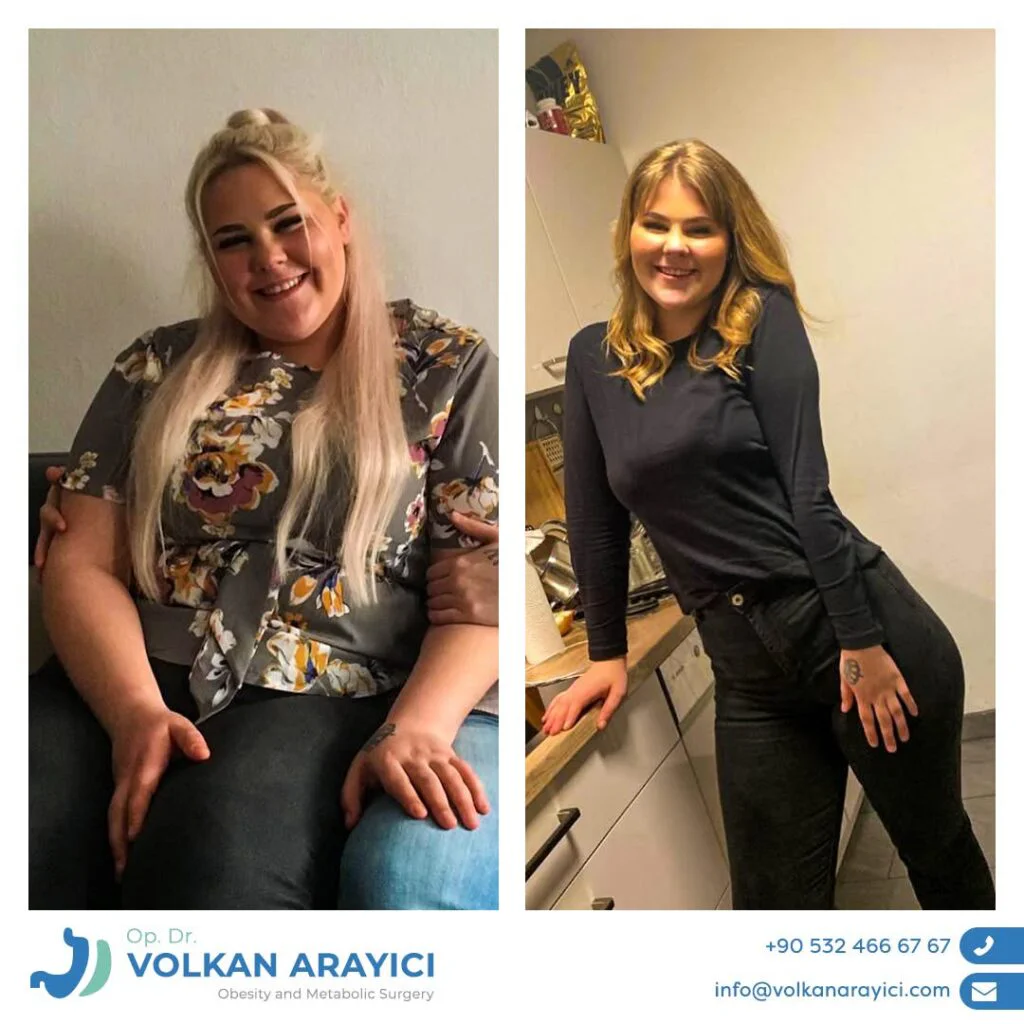 Weight Loss in Turkey: Your Path to a Healthy Life weight loss in turkey before after photo