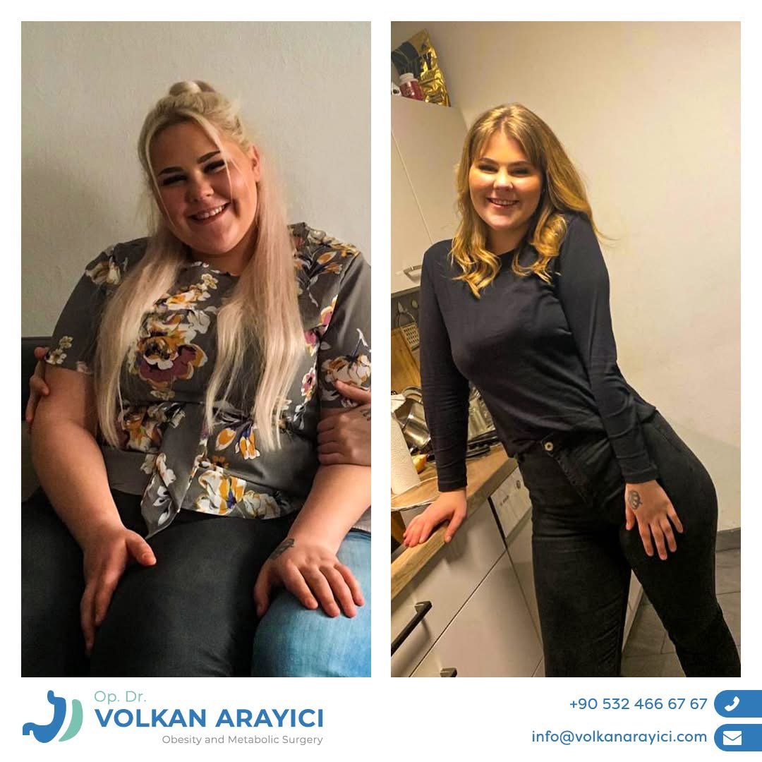 Weight Loss in Turkey: Your Path to a Healthy Life 1 weight loss in turkey before after photo