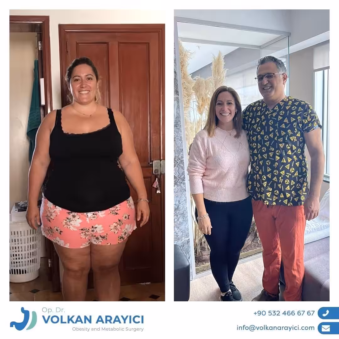 Revisión de Banda Gástrica en turquia antes despues