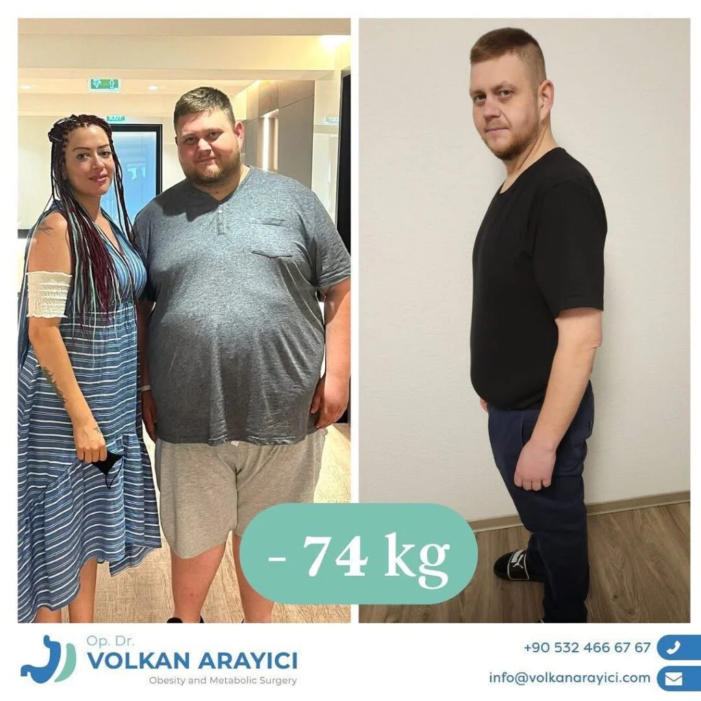 Gastric Band Revision: Your Path to Long-Term Success with Dr. Volkan Arayıcı Gastric Band Revision in Turkey before and after photo