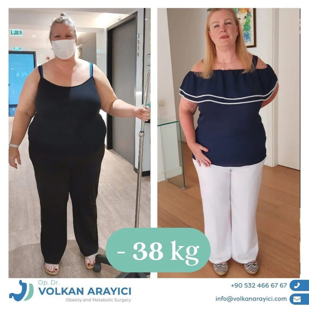 Gastric Band Revision: Your Path to Long-Term Success with Dr. Volkan Arayıcı gastric band revision in turkey before after photo