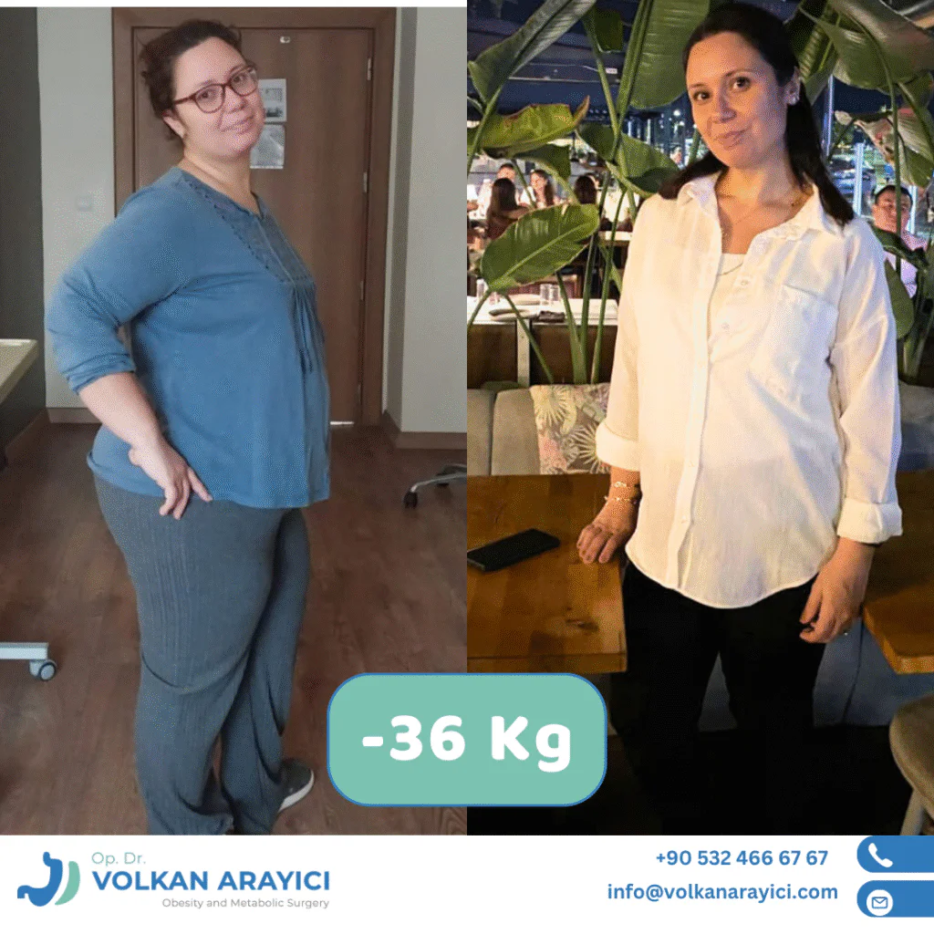 Gastric Band Revision: Your Path to Long-Term Success with Dr. Volkan Arayıcı gastric band revision surgery before after photo