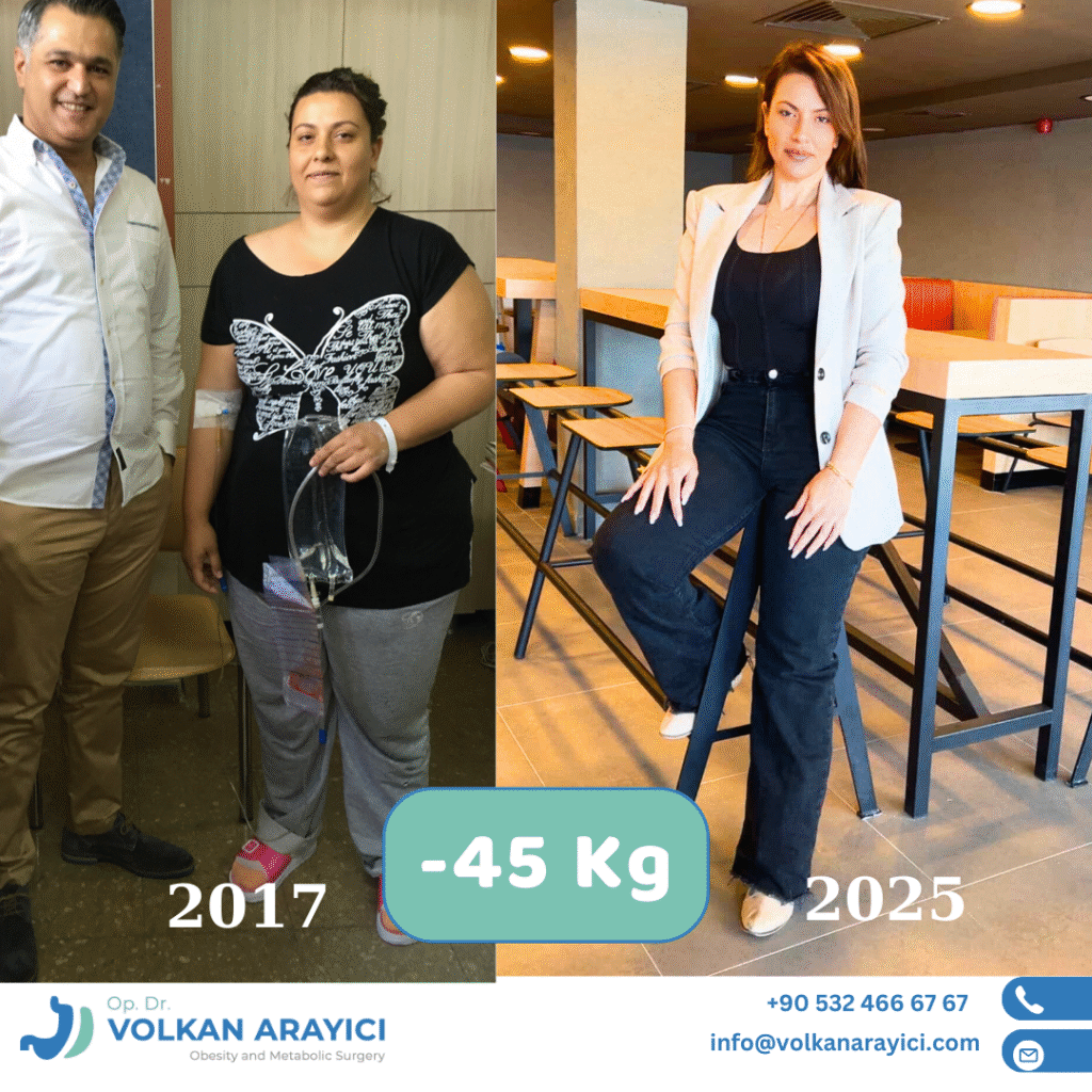 Beste Adipositas Klinik in der Türkei 12 schlauchmagen türkei izmir vorher nachher