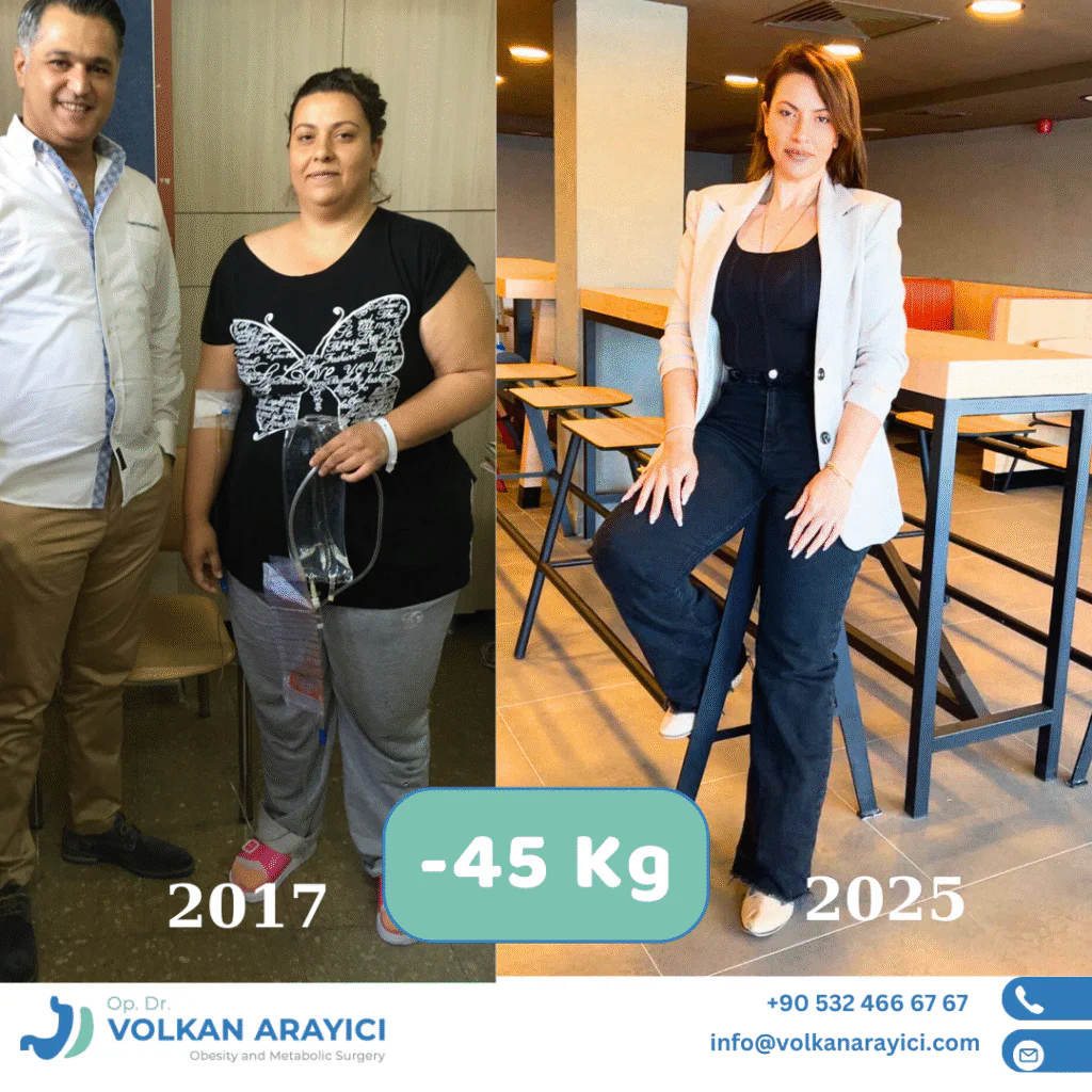 schlauchmagen türkei izmir vorher nachher